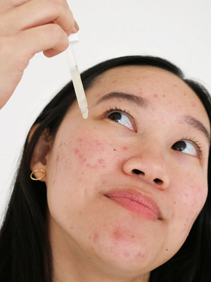 postbiotic acne serum